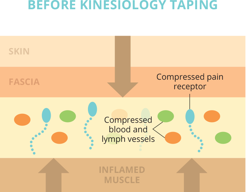 Before Kinesio Taping application