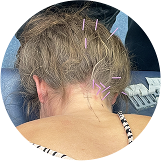 Dry Needling