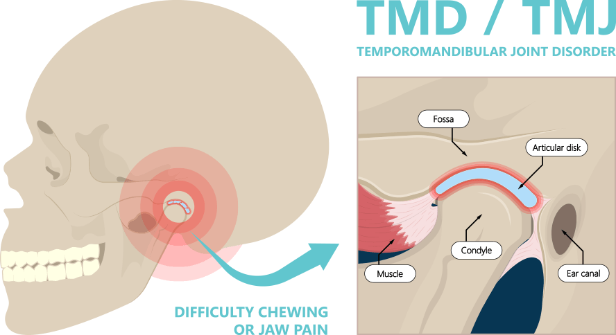 tmj-diagram