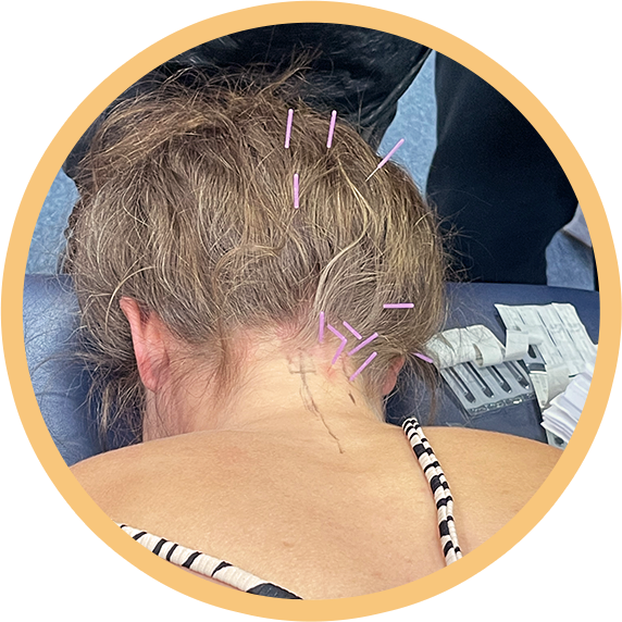 circle-dry-needling